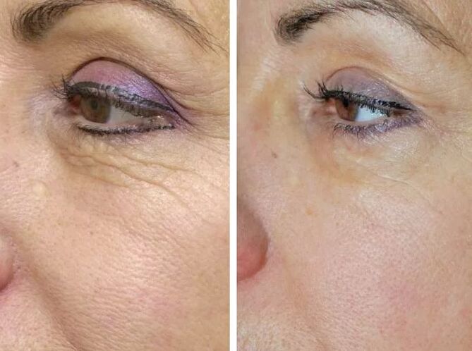 Laser in the ground before and after